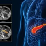 REDMOD Detects Pancreatic Cancer